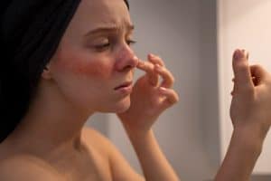 Read more about the article Post-Inflammatory Hyperpigmentation: What is it, Causes & Prevention