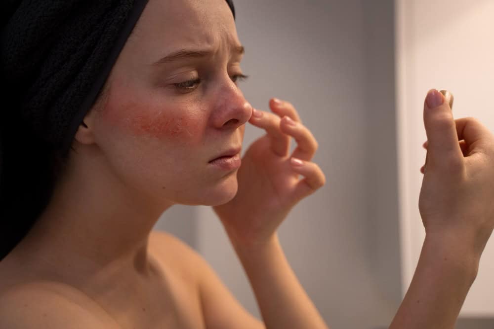 Post-Inflammatory Hyperpigmentation: What is it, Causes & Prevention - post inflammatory hyperpigmentation what is it causes prevention 2 13