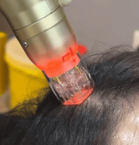 Hair Treatment - Sylfirm x for scalp 1