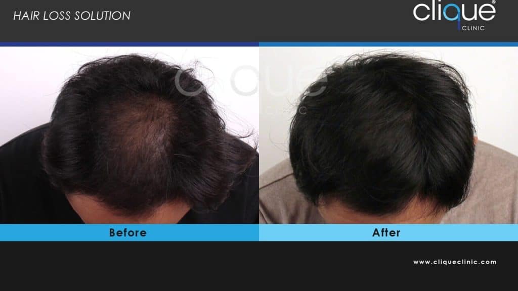 Exosome treatment before and after