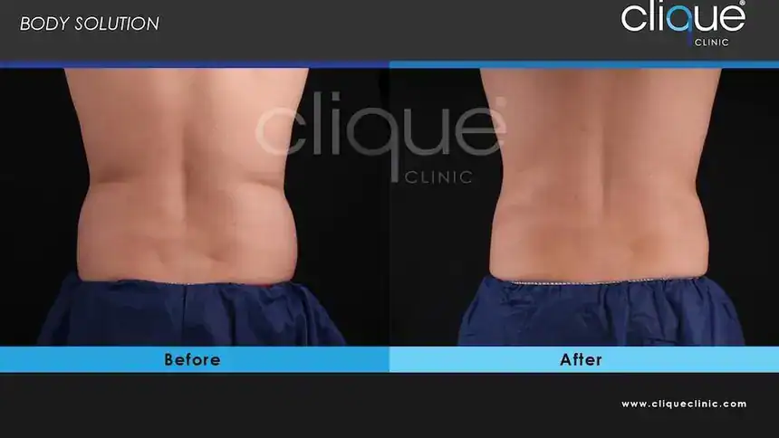 CRISTAL Pro cryolipolysis before and after results showing reduced flank and back fat on a patient at Clique Clinic