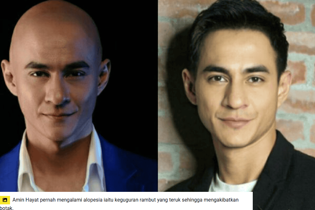 Hair Treatment - hair loss solution 5