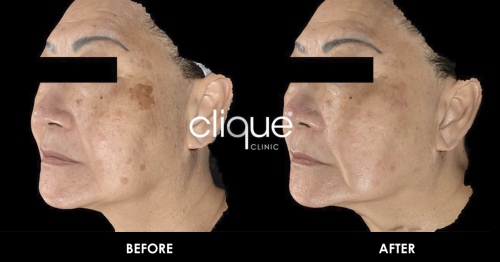 Q-Switched – Vascular Lesions B&A Website Skin_pigment_Medlite_Q-Switched_laser_Clique_Clinic
