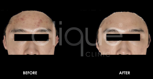 Acne_Tixel_Clique_Clinic B&A Acne_Tixel_Clique_Clinic